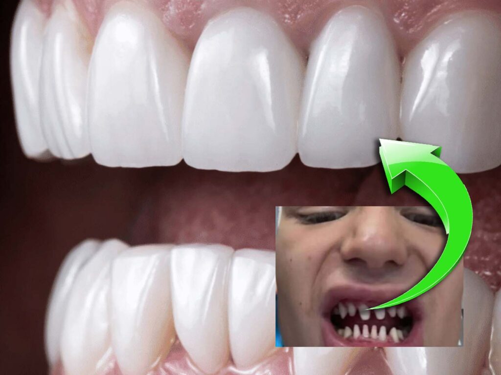 Veneers Zähne